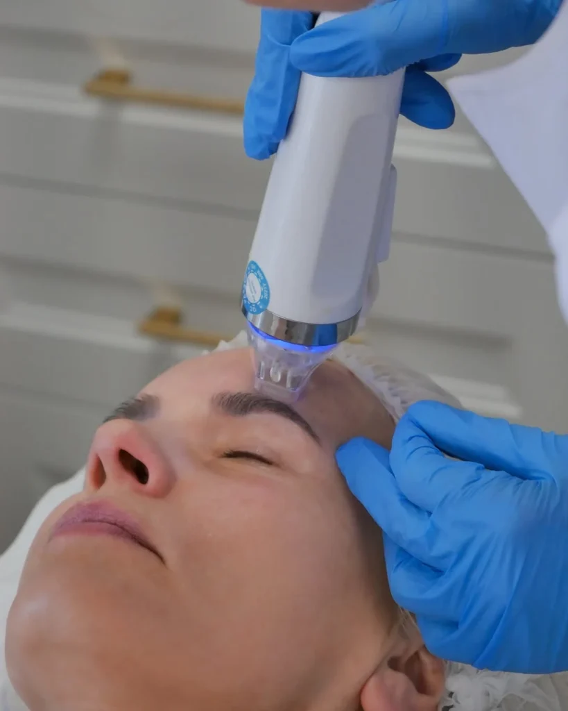 Soin de microneedling professionnel appliqué sur le front lors d’un traitement esthétique du visage