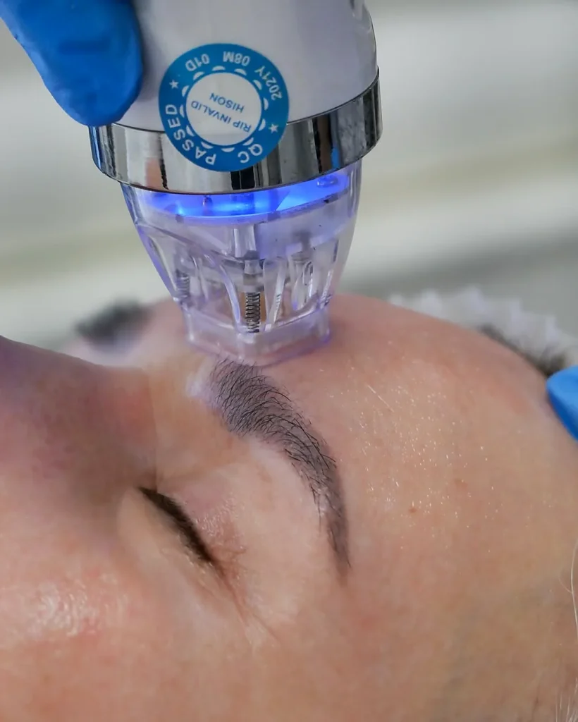Gros plan d’un traitement de microneedling sur le front et la zone du sourcil en cabinet esthétique