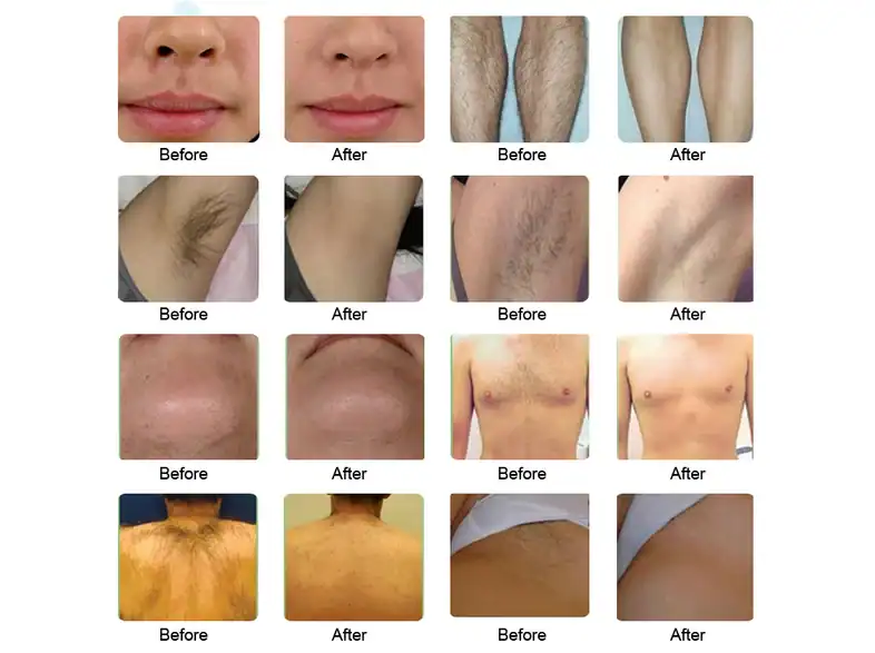 Before and after laser hair removal results on lips, legs, underarms, chest and back