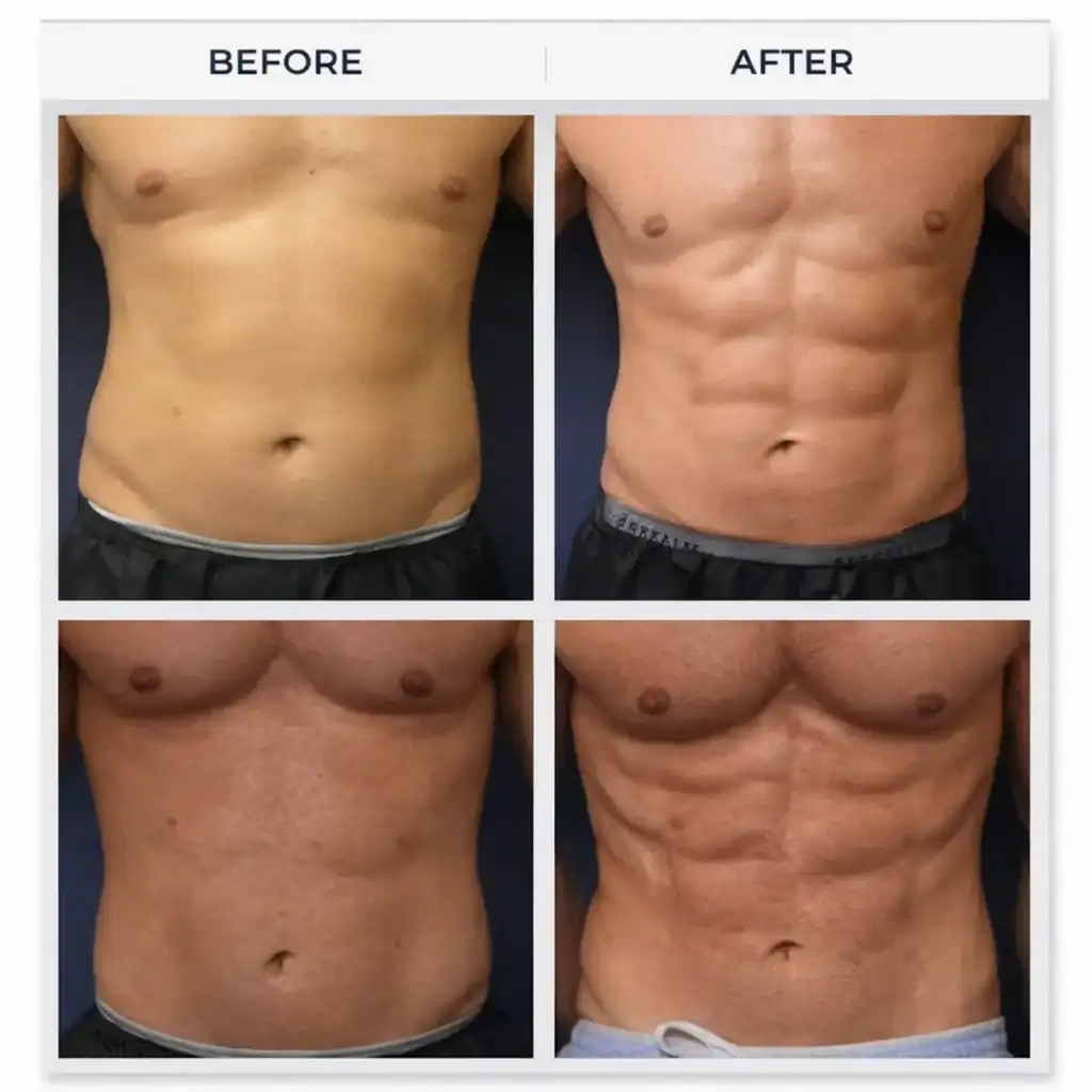 HIEMT before and after showing improved abdominal muscle definition and body contouring in a male patient