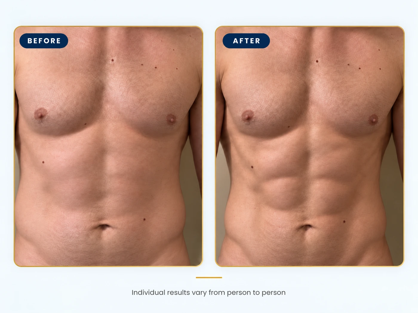 Before and after comparison of a man's chest and abdomen, individual results vary from person to person