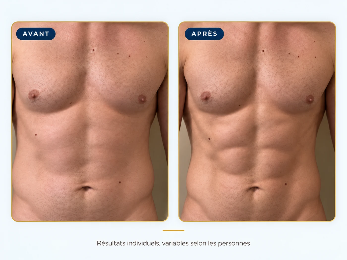 Comparatif avant et après du buste et de l'abdomen d'un homme, résultats individuels variables selon les personnes