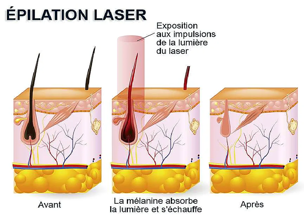 Schéma du principe d'épilation laser : action de la lumière sur le follicule pileux